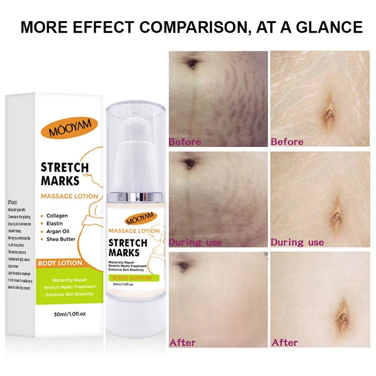 anti stretch mark treatment anti stretch mark treatment