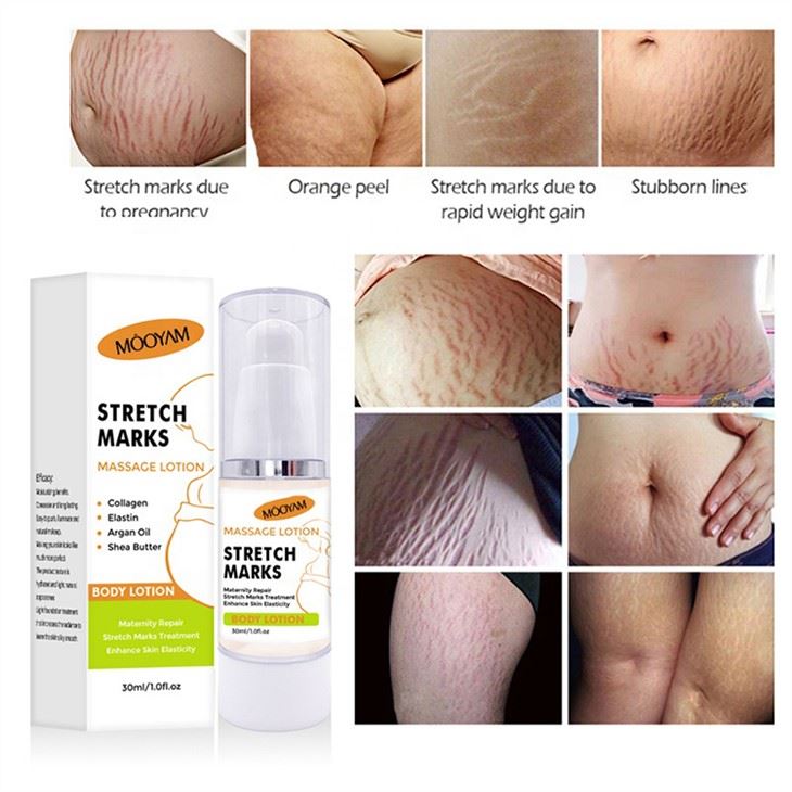 Effective Stretch Mark Removal Cream