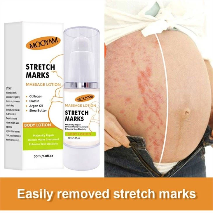 Effective Stretch Mark Removal Cream
